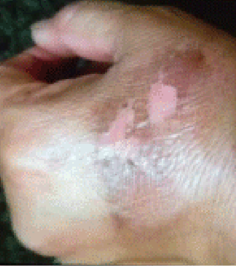 Fast food worker showing injuries inflicted during work