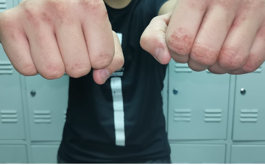 male fast food worker showing injuries sustained while at work